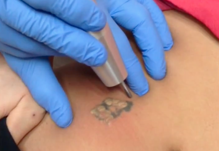 Laser Q-switched Per Eliminare Tatuaggi